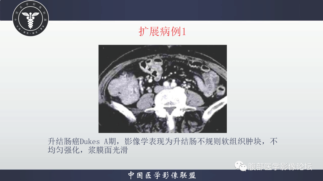 影像PPT - 【病例】结肠癌1例CT影像鉴别诊断思路-22