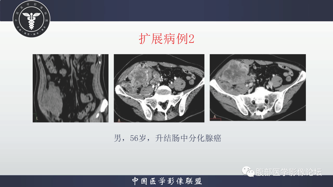 影像PPT - 【病例】结肠癌1例CT影像鉴别诊断思路-23