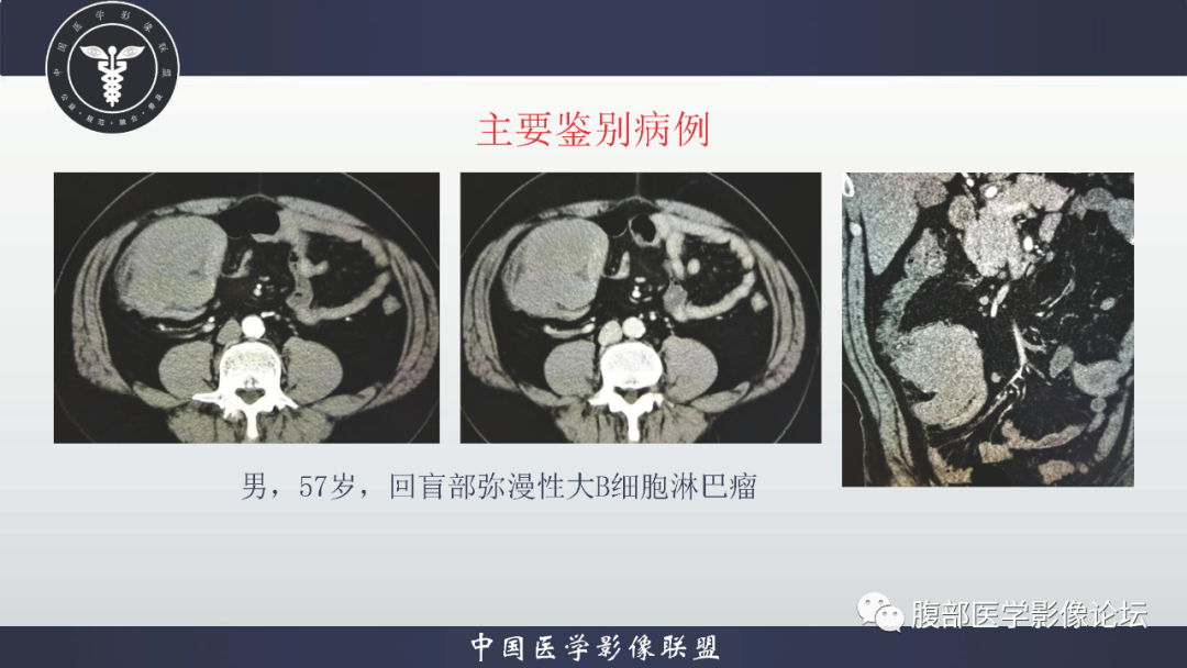 影像PPT - 【病例】结肠癌1例CT影像鉴别诊断思路-24