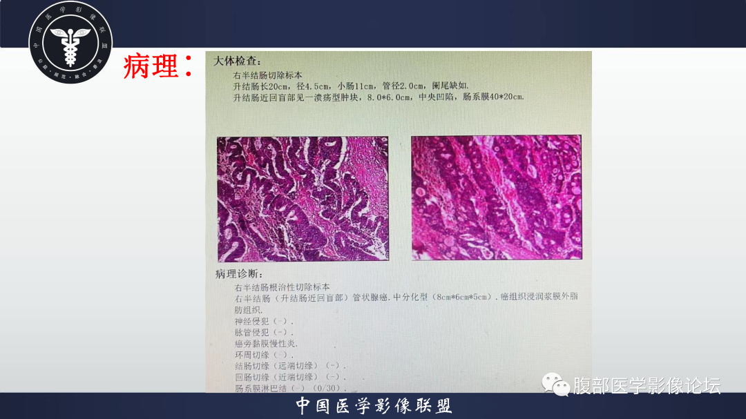 影像PPT - 【病例】结肠癌1例CT影像鉴别诊断思路-18