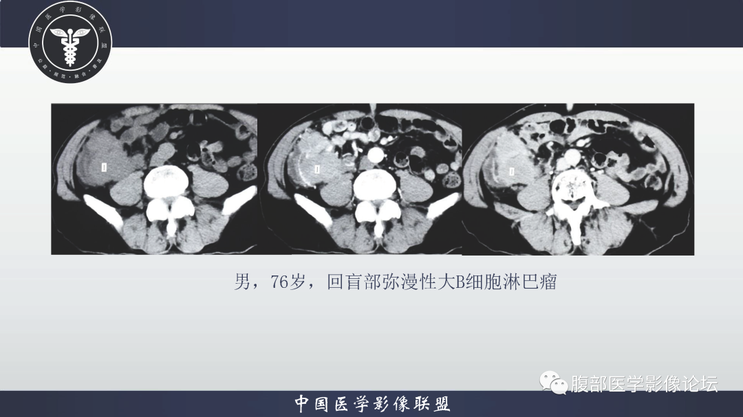 影像PPT - 【病例】结肠癌1例CT影像鉴别诊断思路-25