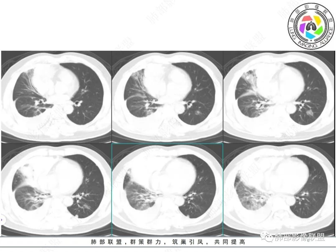 影像PPT - 【病例】纵隔占位—胸腺类癌1例CT影像-6 影像PPT - 【病例】纵隔占位—胸腺类癌1例CT影像-6