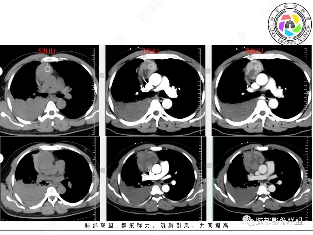 影像PPT - 【病例】纵隔占位—胸腺类癌1例CT影像-7 影像PPT - 【病例】纵隔占位—胸腺类癌1例CT影像-7