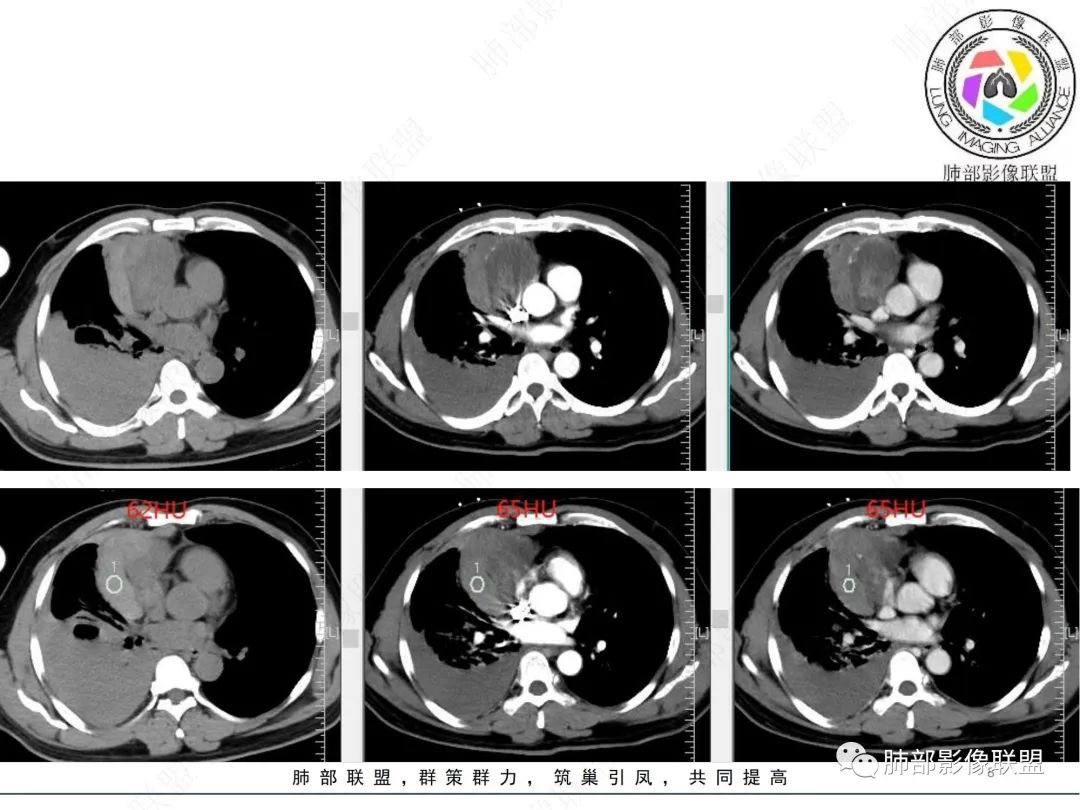 影像PPT - 【病例】纵隔占位—胸腺类癌1例CT影像-8 影像PPT - 【病例】纵隔占位—胸腺类癌1例CT影像-8