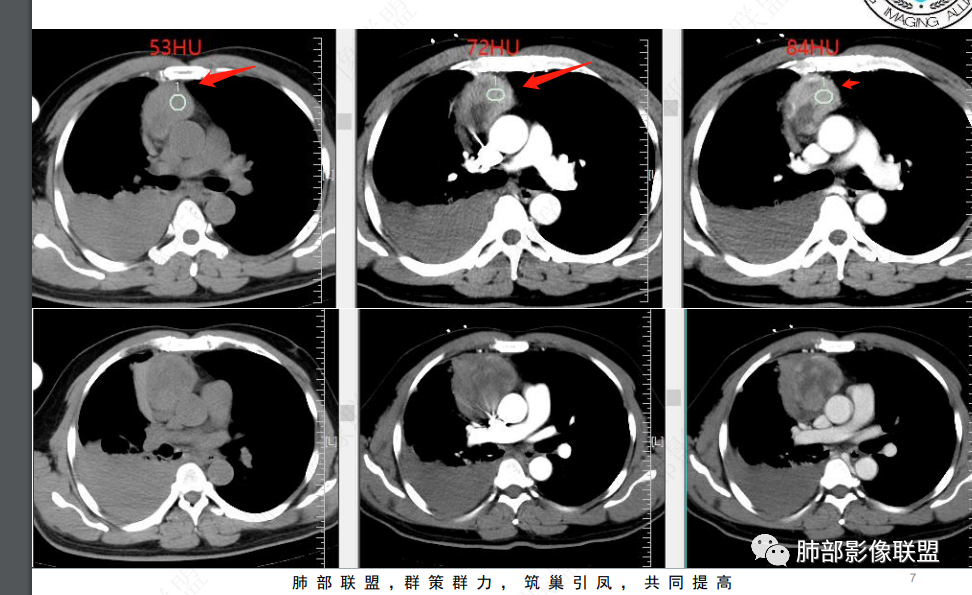 影像PPT - 【病例】纵隔占位—胸腺类癌1例CT影像-16 影像PPT - 【病例】纵隔占位—胸腺类癌1例CT影像-16