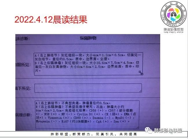 影像PPT - 【病例】纵隔占位—胸腺类癌1例CT影像-19 影像PPT - 【病例】纵隔占位—胸腺类癌1例CT影像-19
