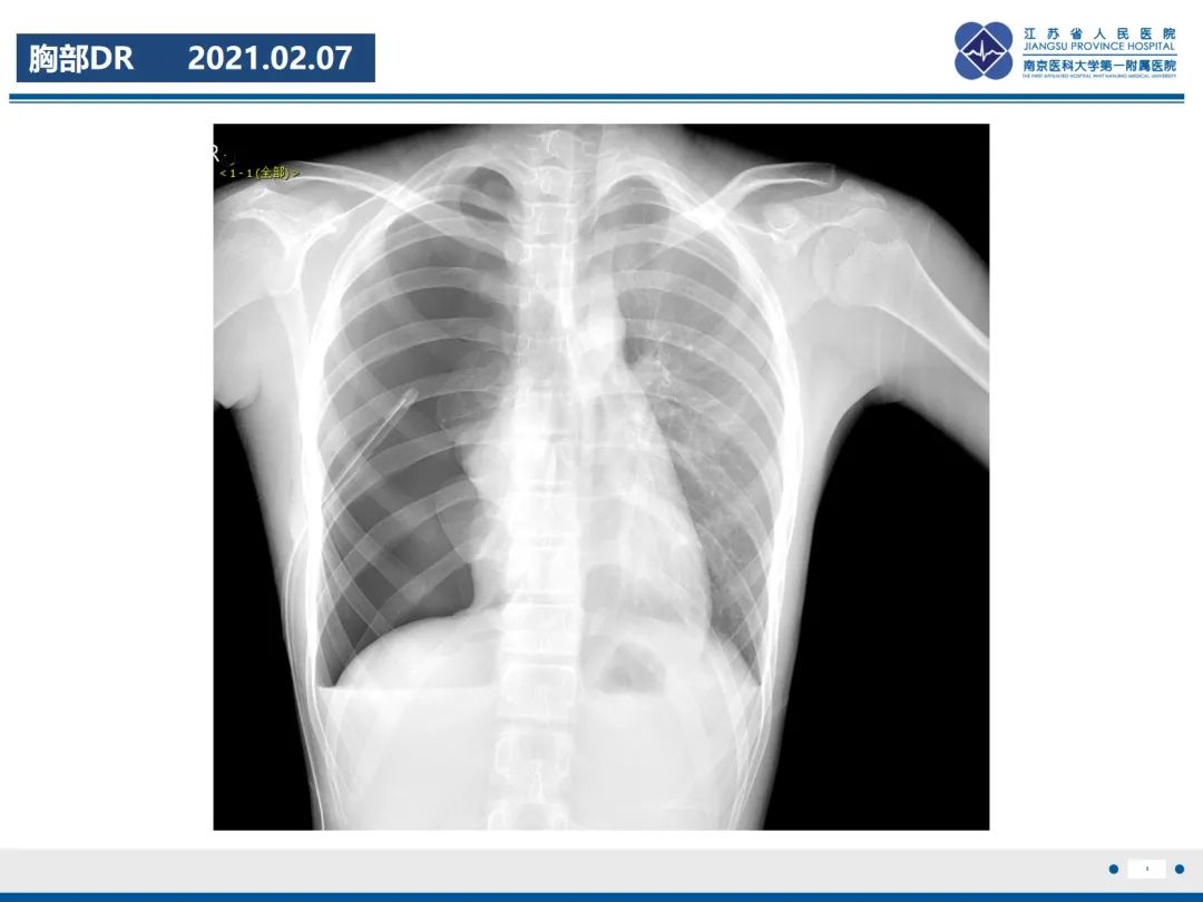 影像PPT - 【PPT】原发性自发性气胸-3