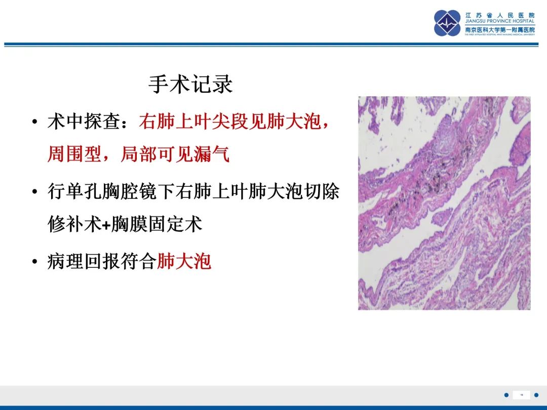 影像PPT - 【PPT】原发性自发性气胸-16