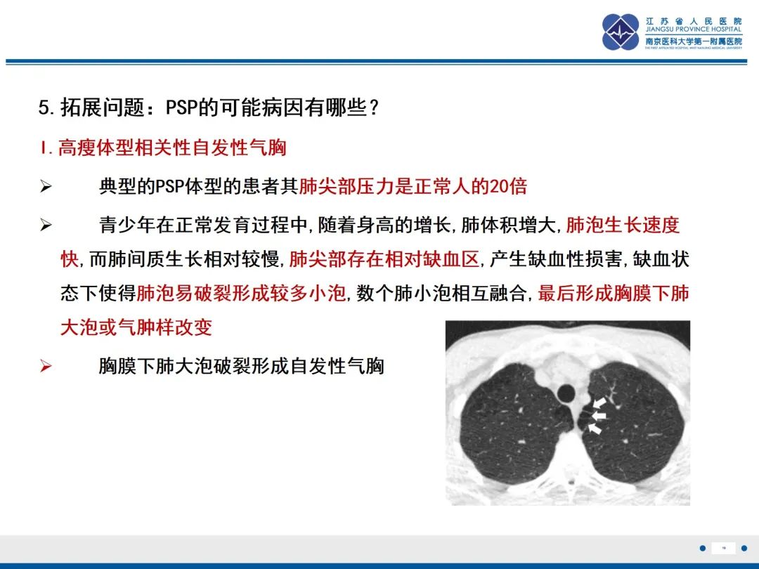 影像PPT - 【PPT】原发性自发性气胸-19
