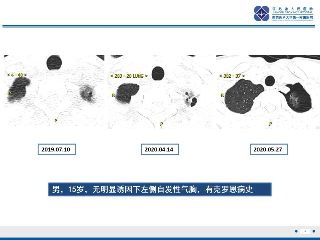 影像PPT - 【PPT】原发性自发性气胸-22