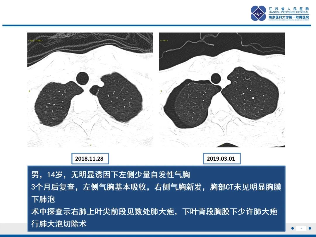 影像PPT - 【PPT】原发性自发性气胸-23