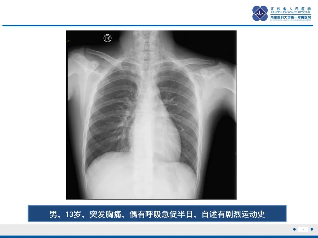 影像PPT - 【PPT】原发性自发性气胸-24