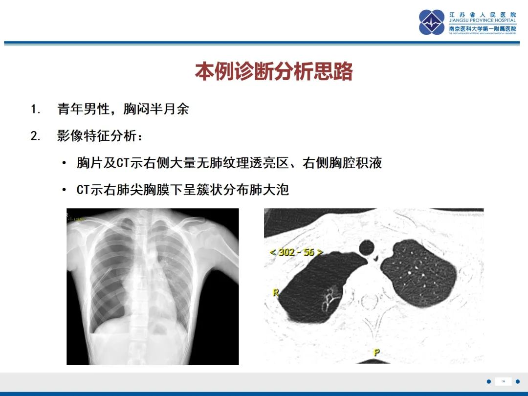 影像PPT - 【PPT】原发性自发性气胸-26