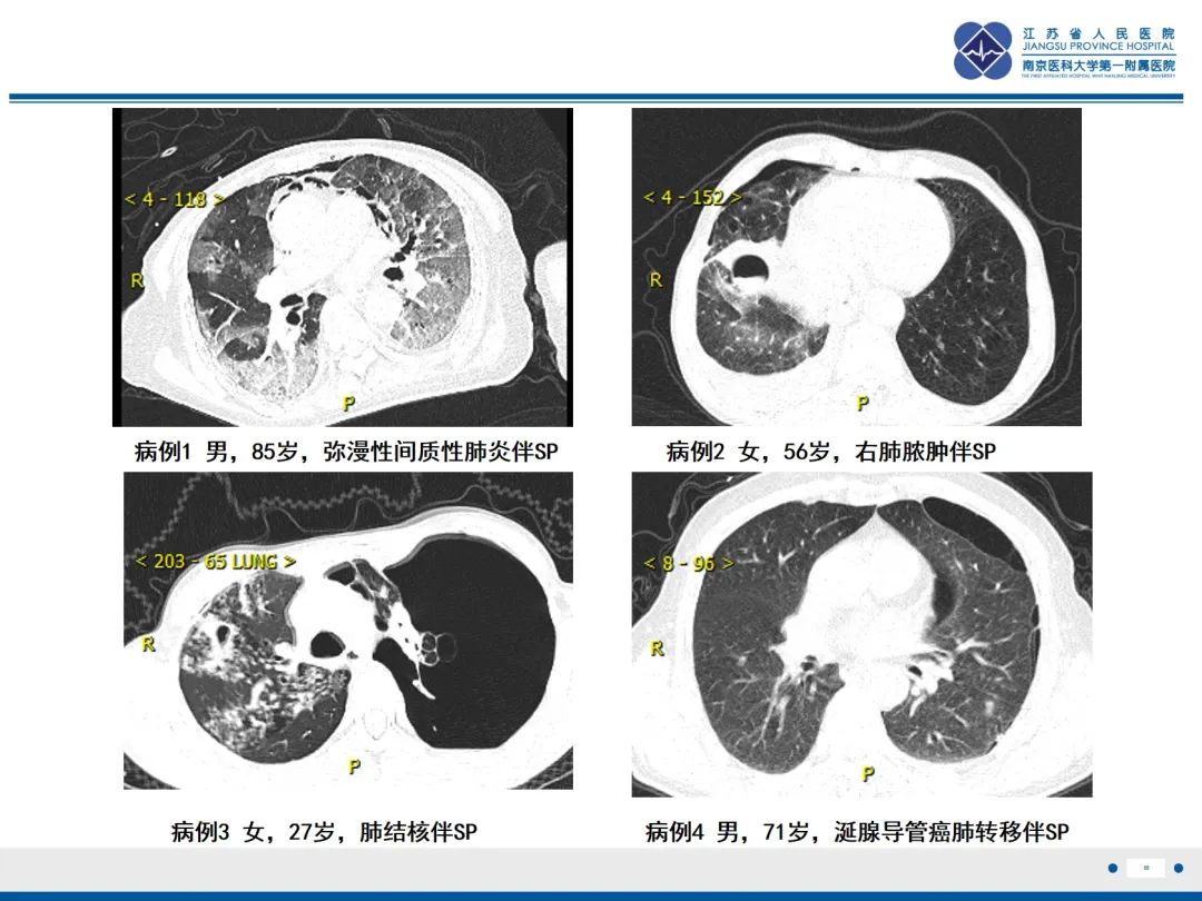 影像PPT - 【PPT】原发性自发性气胸-28