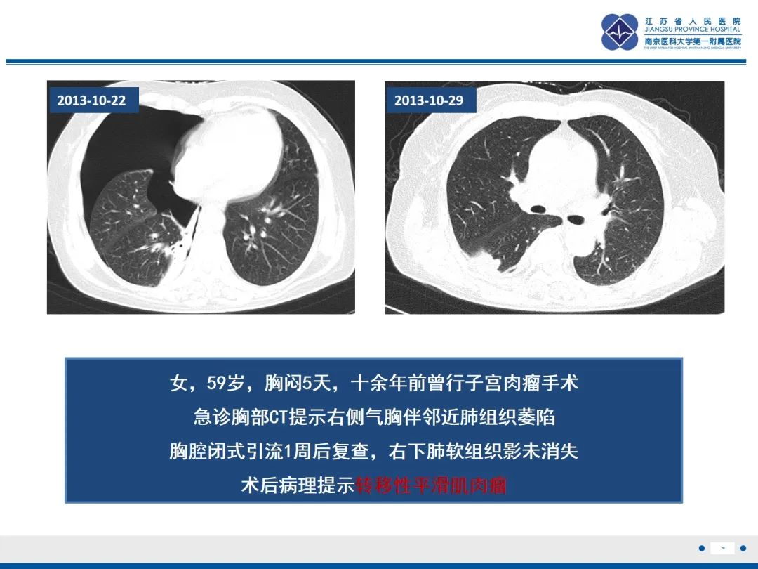 影像PPT - 【PPT】原发性自发性气胸-29