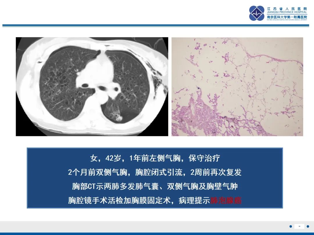 影像PPT - 【PPT】原发性自发性气胸-30