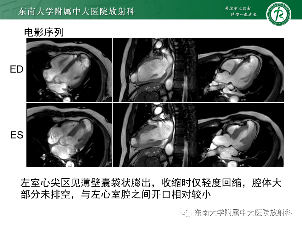 影像PPT - 【PPT】心尖局限性膨出病例-3