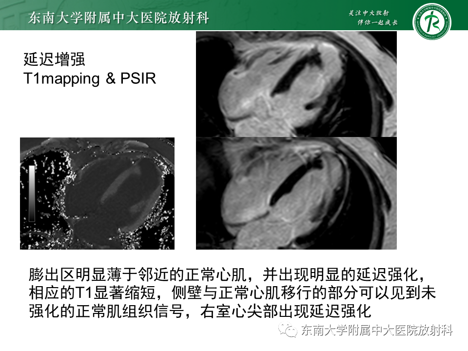 影像PPT - 【PPT】心尖局限性膨出病例-5