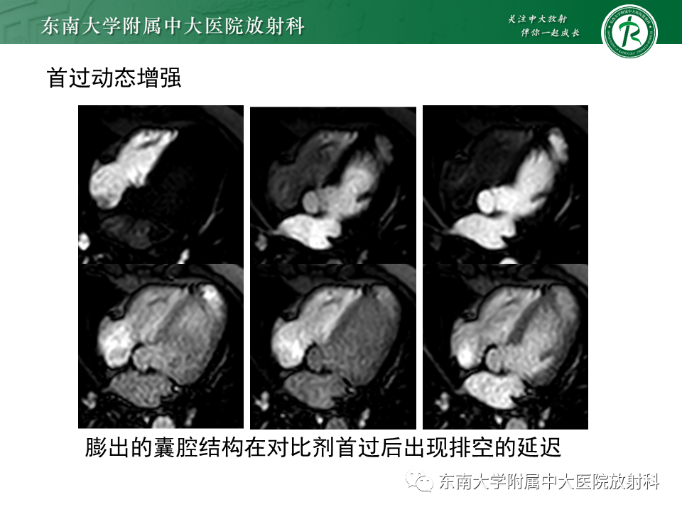 影像PPT - 【PPT】心尖局限性膨出病例-4
