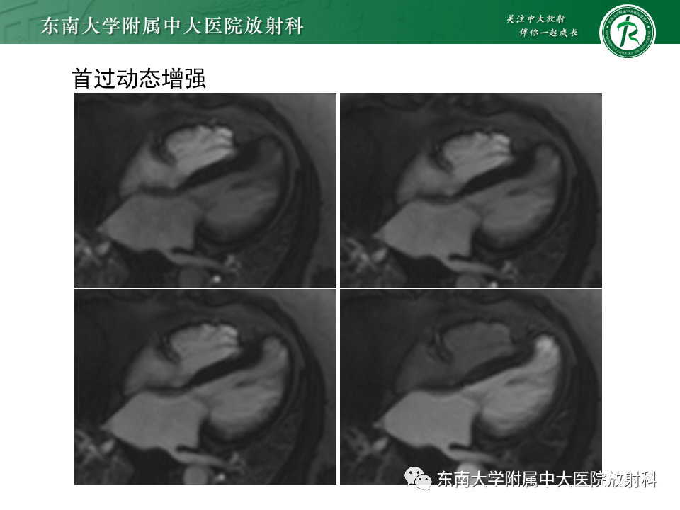 影像PPT - 【PPT】心尖局限性膨出病例-8