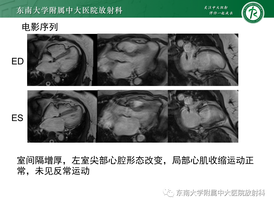 影像PPT - 【PPT】心尖局限性膨出病例-7