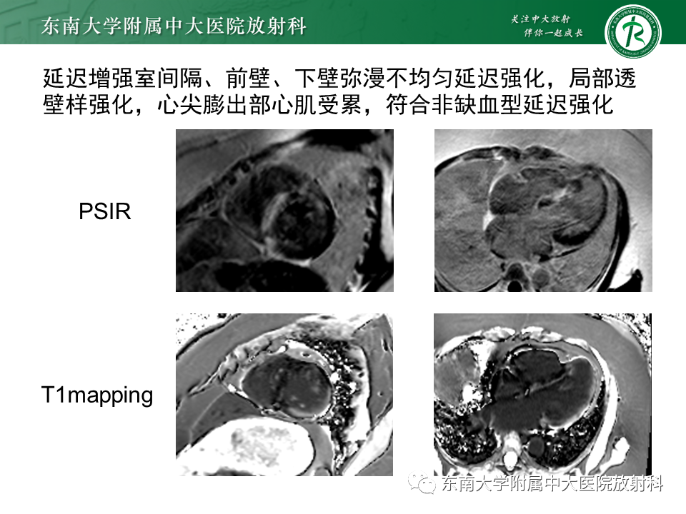 影像PPT - 【PPT】心尖局限性膨出病例-9