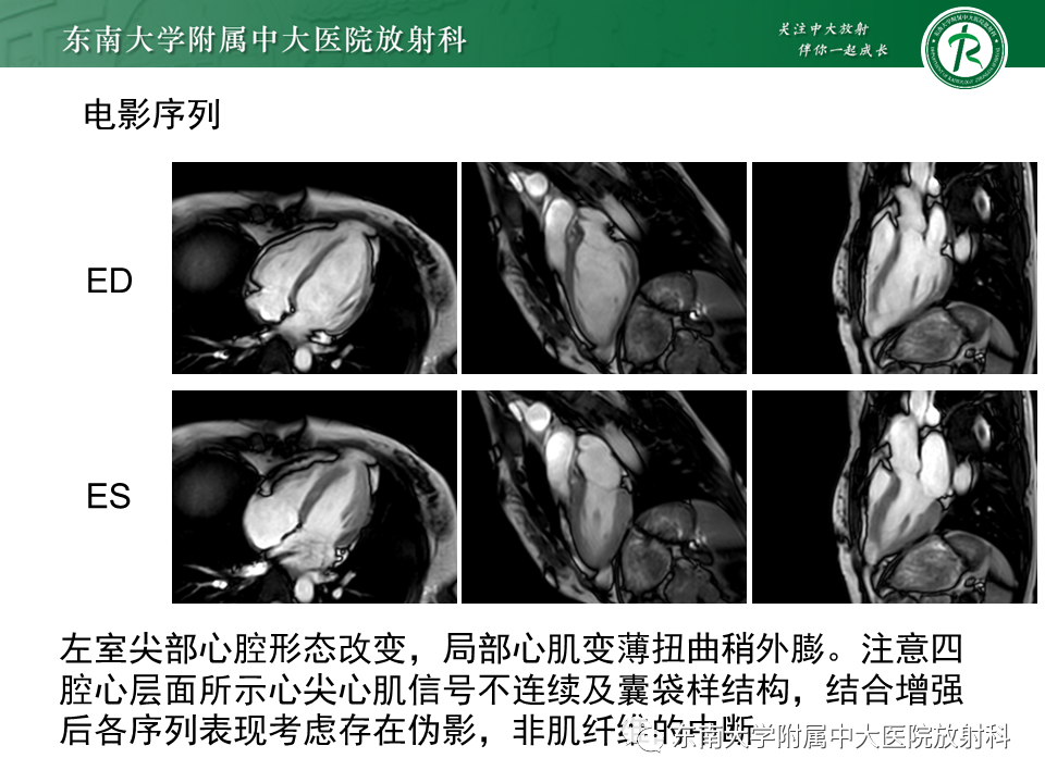 影像PPT - 【PPT】心尖局限性膨出病例-11
