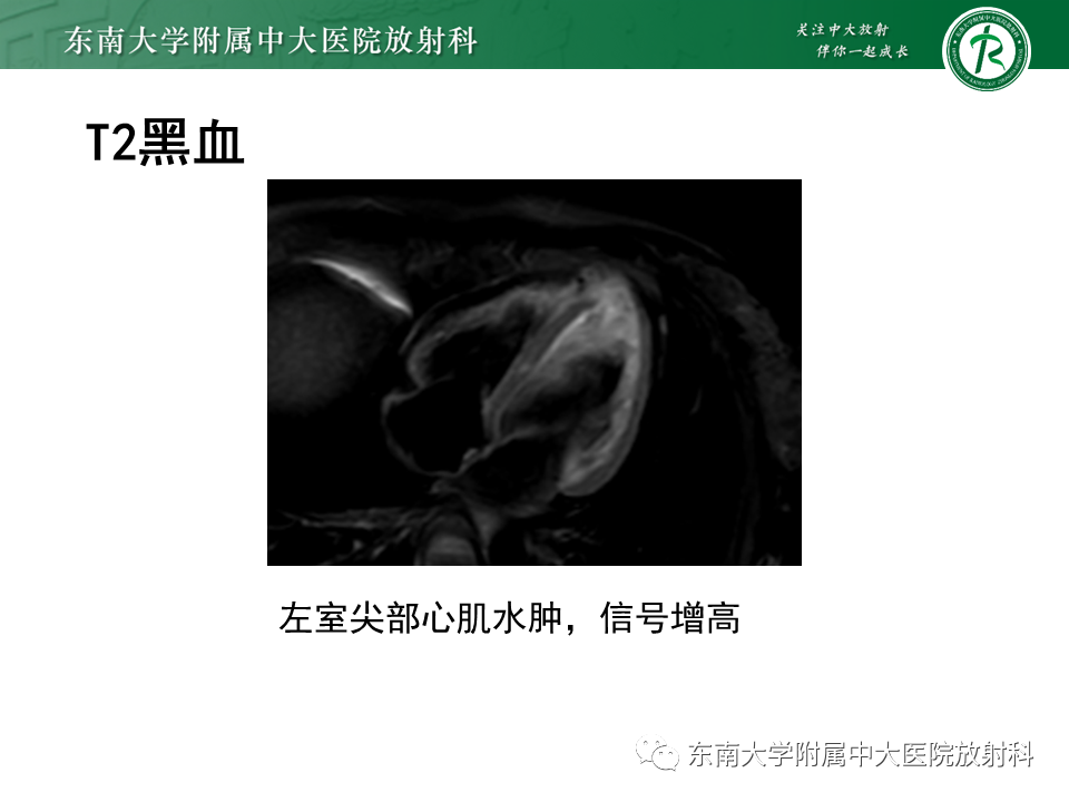 影像PPT - 【PPT】心尖局限性膨出病例-12