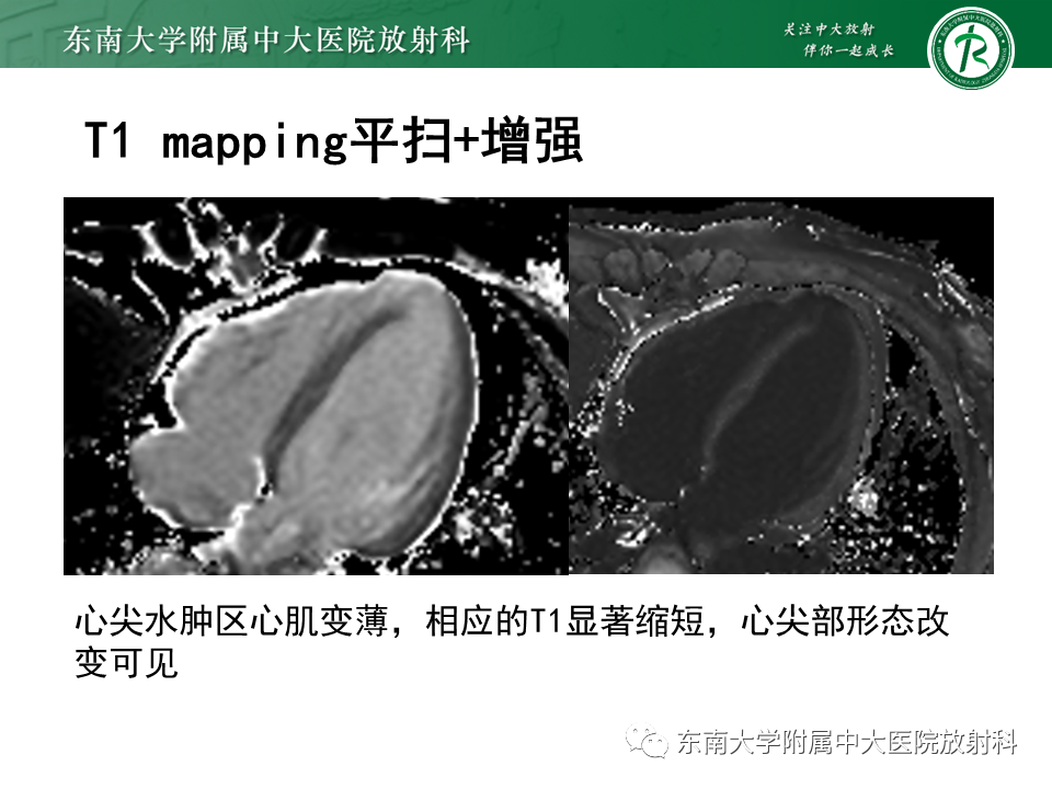 影像PPT - 【PPT】心尖局限性膨出病例-14