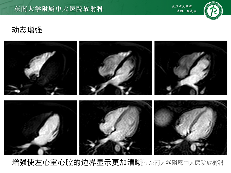 影像PPT - 【PPT】心尖局限性膨出病例-13