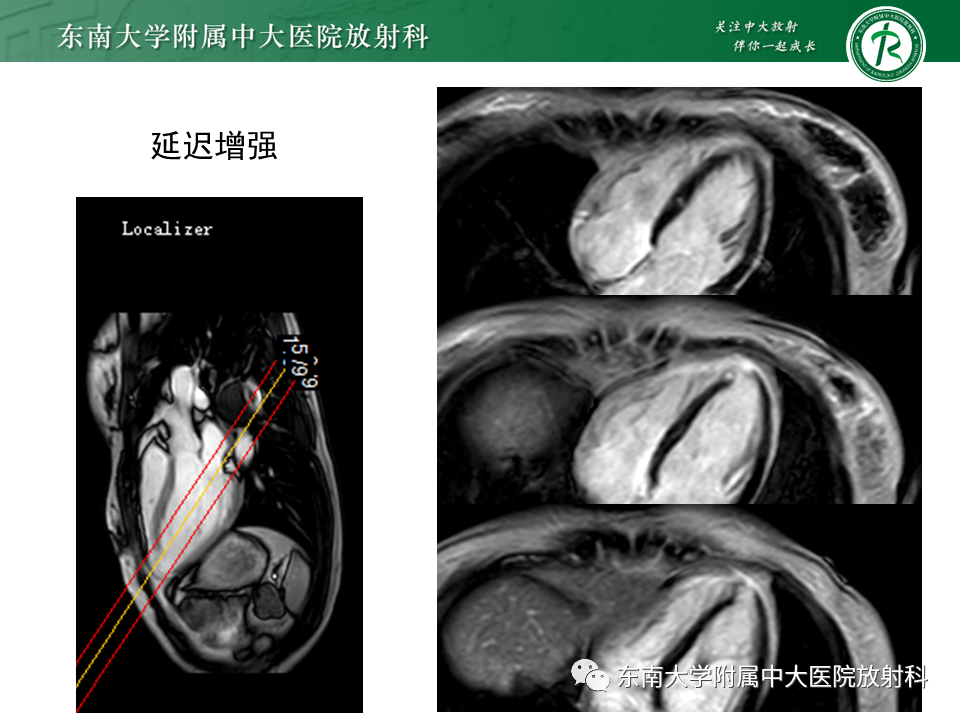 影像PPT - 【PPT】心尖局限性膨出病例-15
