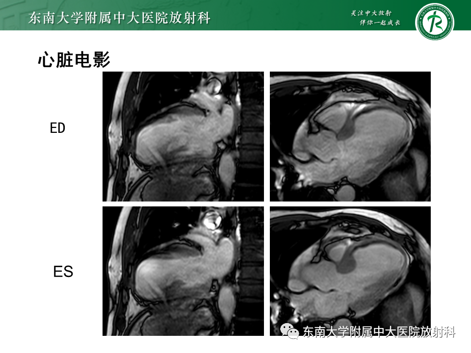 影像PPT - 【PPT】心尖局限性膨出病例-25