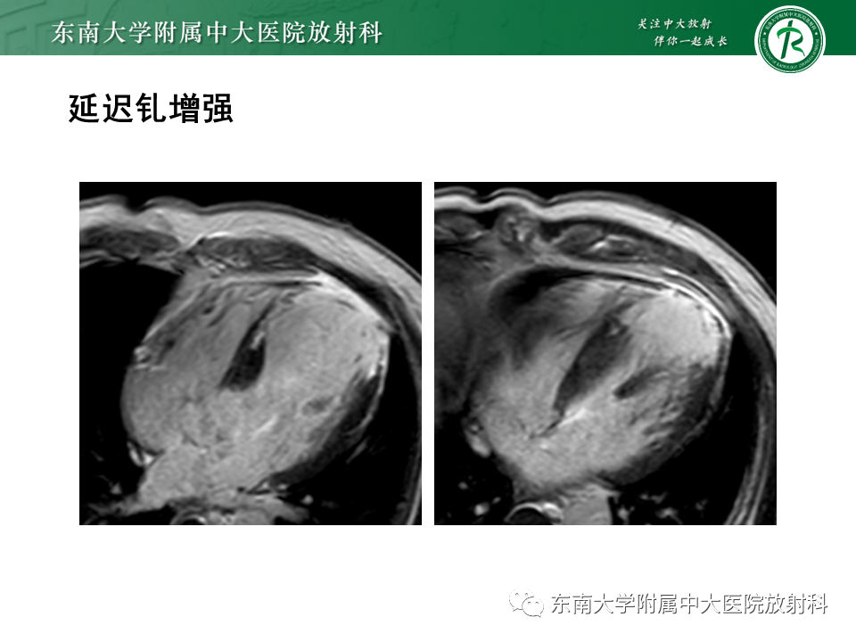 影像PPT - 【PPT】心尖局限性膨出病例-26