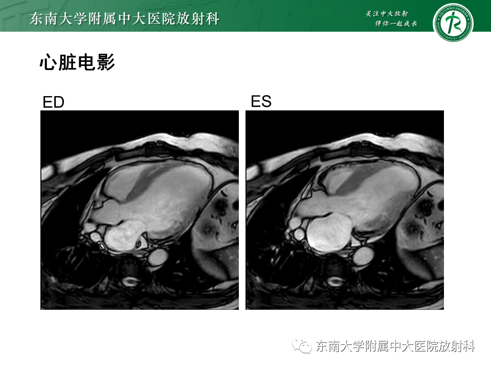 影像PPT - 【PPT】心尖局限性膨出病例-28