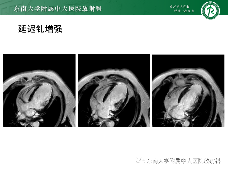 影像PPT - 【PPT】心尖局限性膨出病例-29