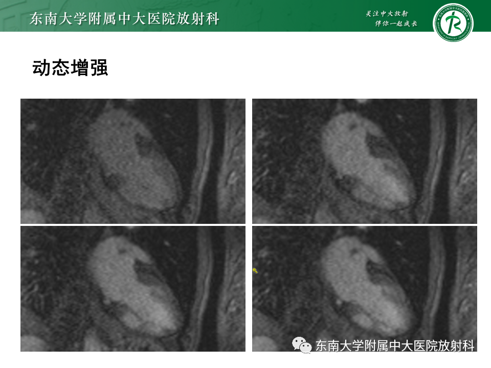 影像PPT - 【PPT】心尖局限性膨出病例-32