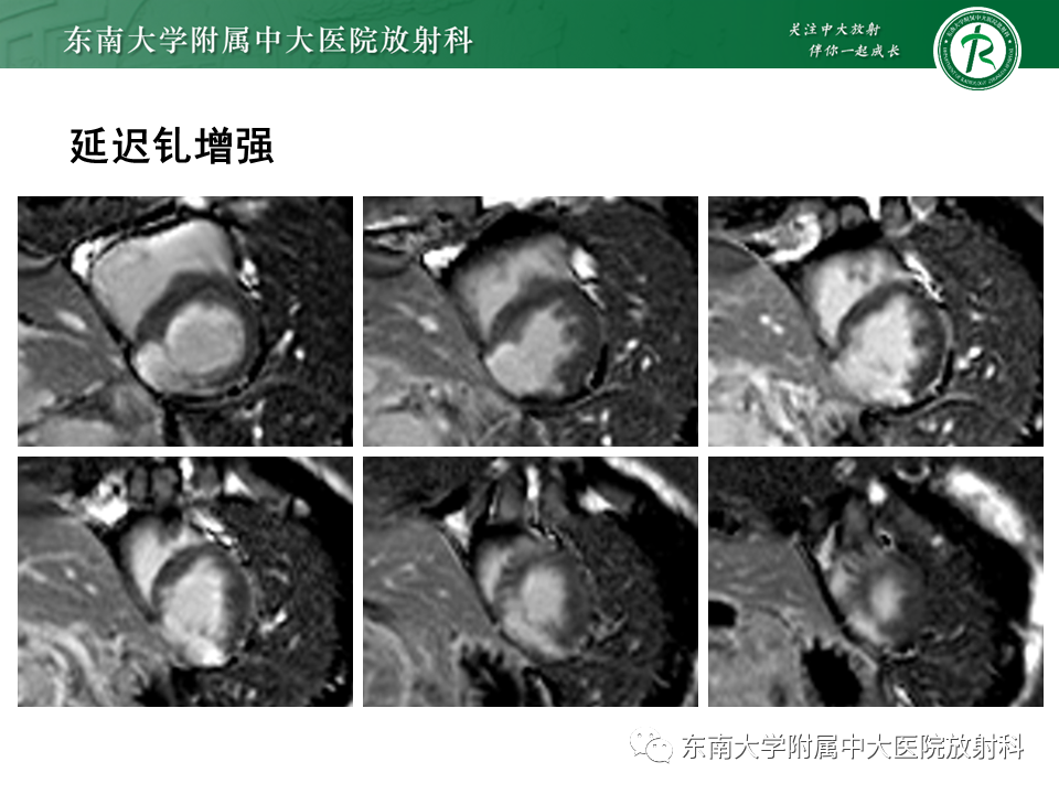 影像PPT - 【PPT】心尖局限性膨出病例-33