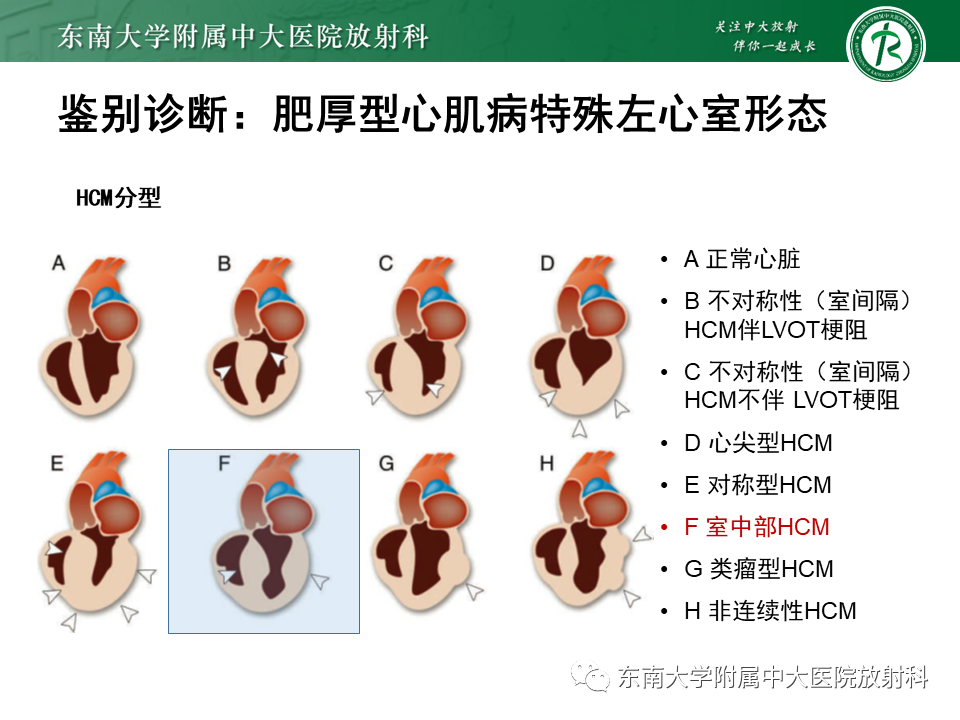 影像PPT - 【PPT】心尖局限性膨出病例-34