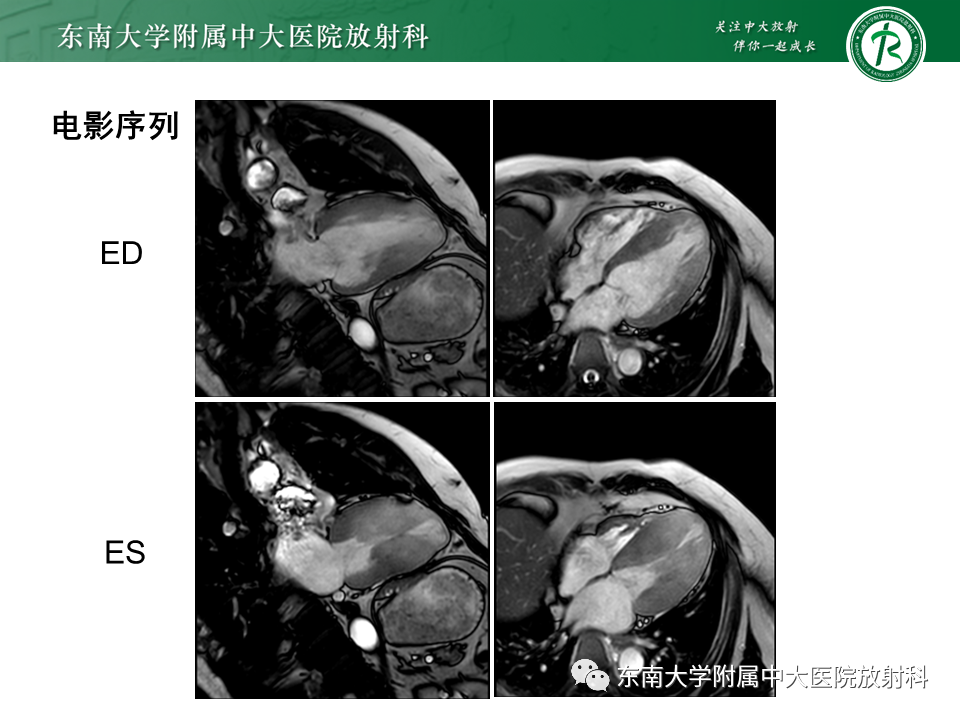 影像PPT - 【PPT】心尖局限性膨出病例-36