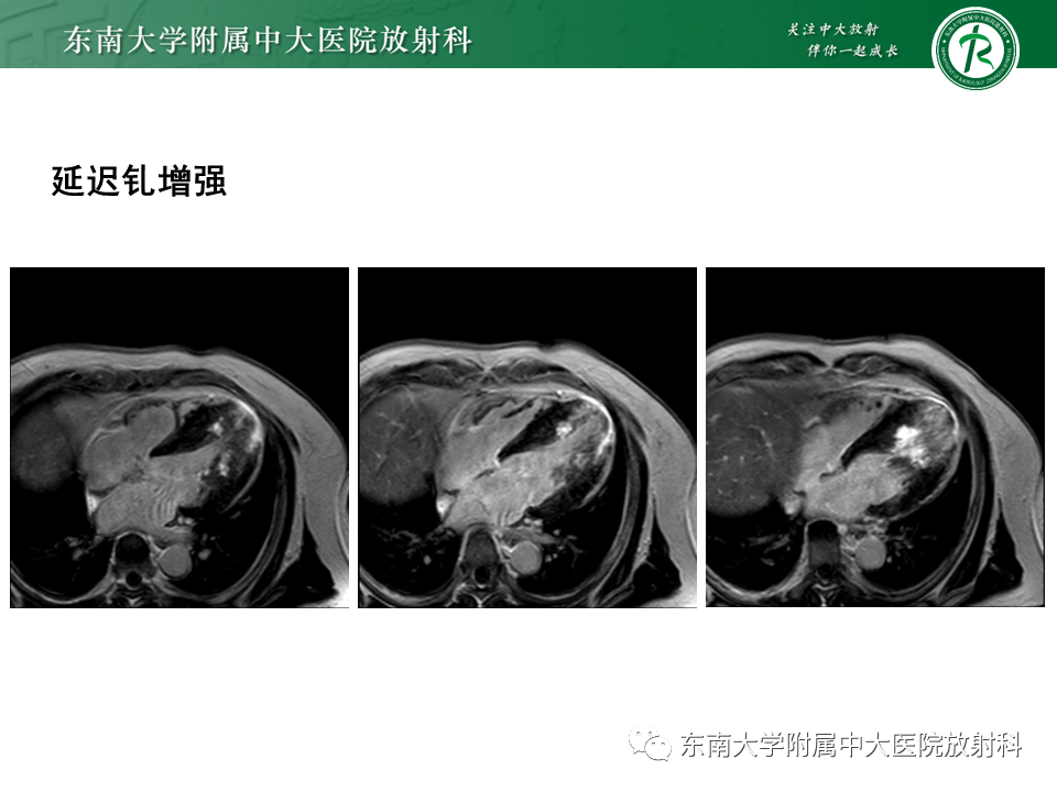 影像PPT - 【PPT】心尖局限性膨出病例-37