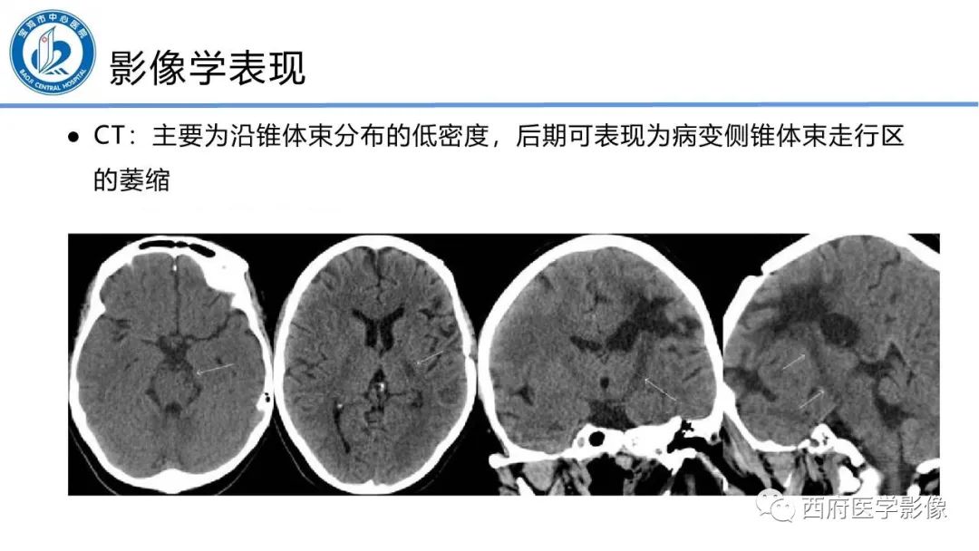 影像PPT - 【PPT】华勒氏变性的影像诊断-9