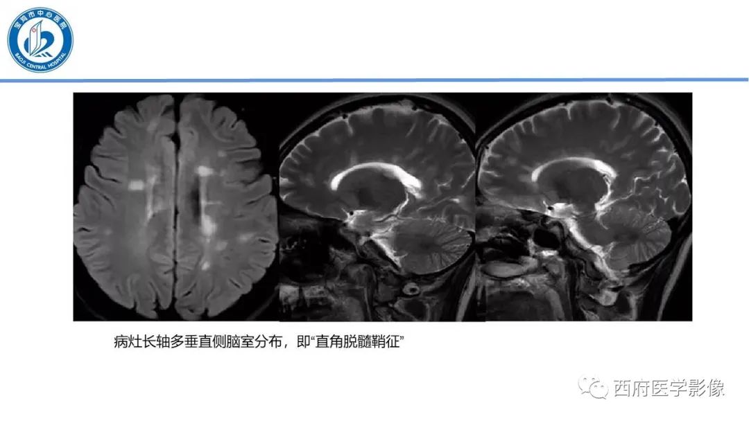 影像PPT - 【PPT】华勒氏变性的影像诊断-14