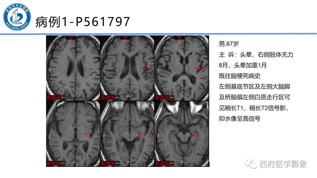 影像PPT - 【PPT】华勒氏变性的影像诊断-15