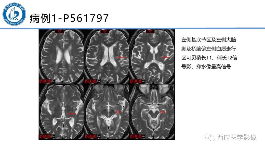 影像PPT - 【PPT】华勒氏变性的影像诊断-16