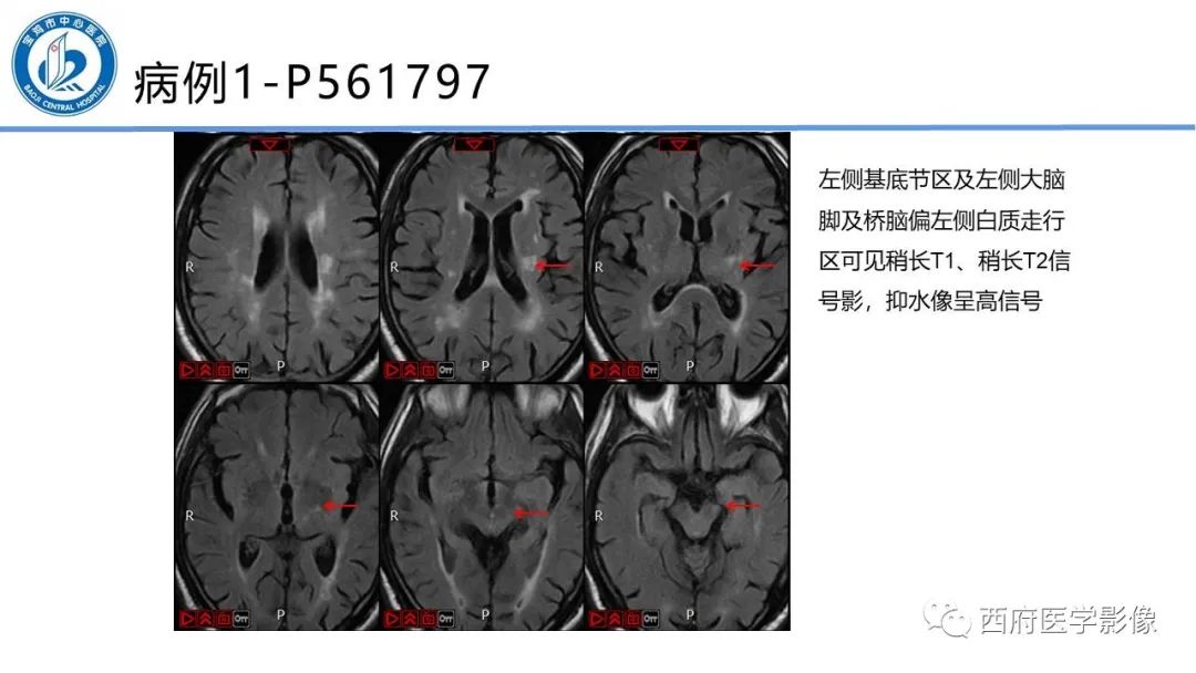 影像PPT - 【PPT】华勒氏变性的影像诊断-17