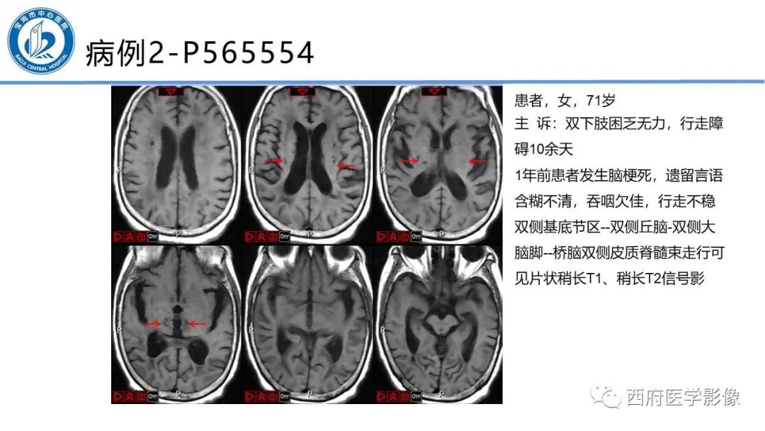 影像PPT - 【PPT】华勒氏变性的影像诊断-18
