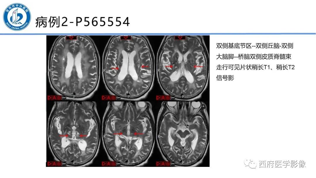 影像PPT - 【PPT】华勒氏变性的影像诊断-19
