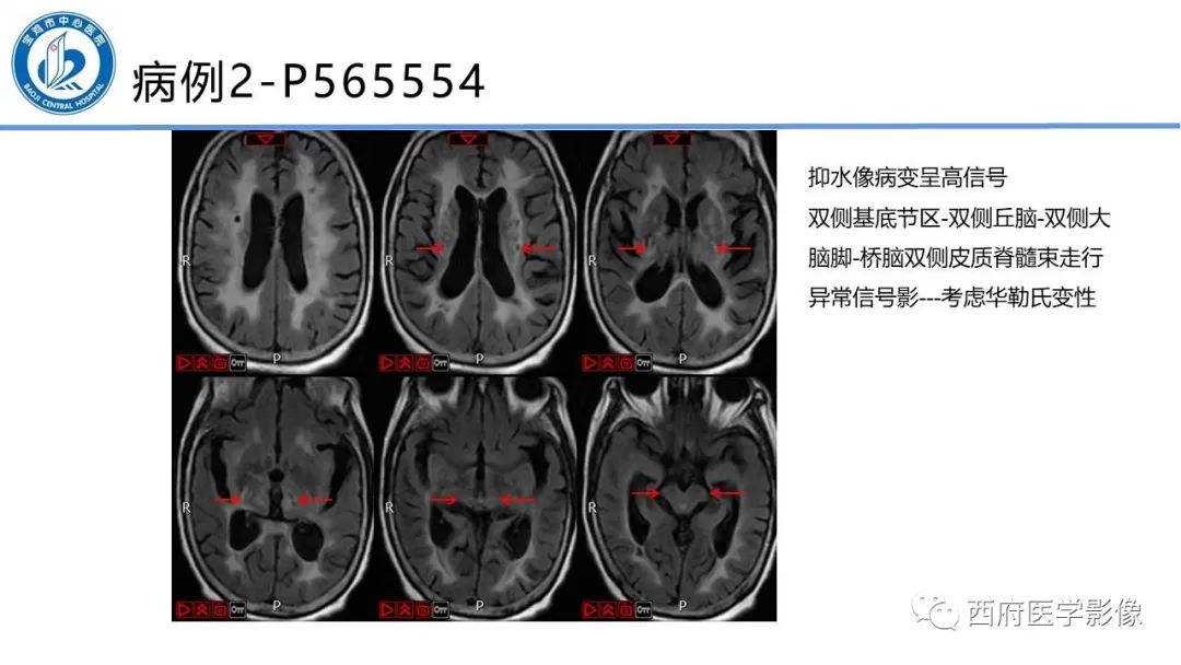 影像PPT - 【PPT】华勒氏变性的影像诊断-20