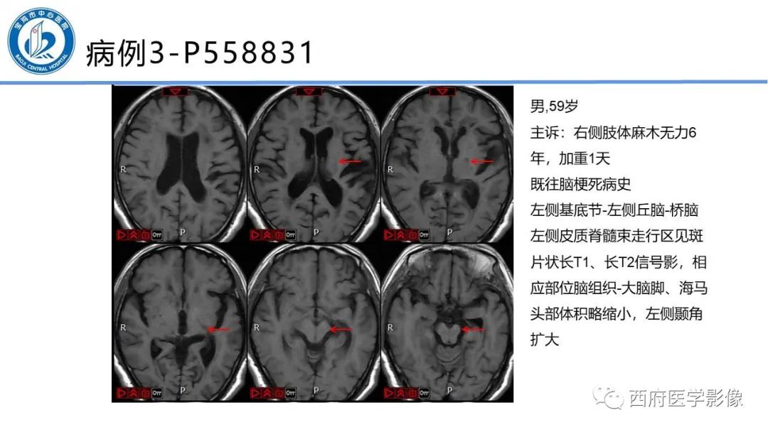 影像PPT - 【PPT】华勒氏变性的影像诊断-21