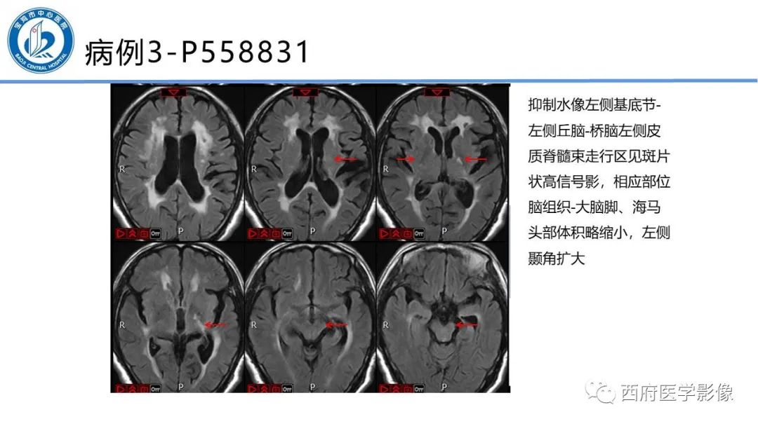 影像PPT - 【PPT】华勒氏变性的影像诊断-23
